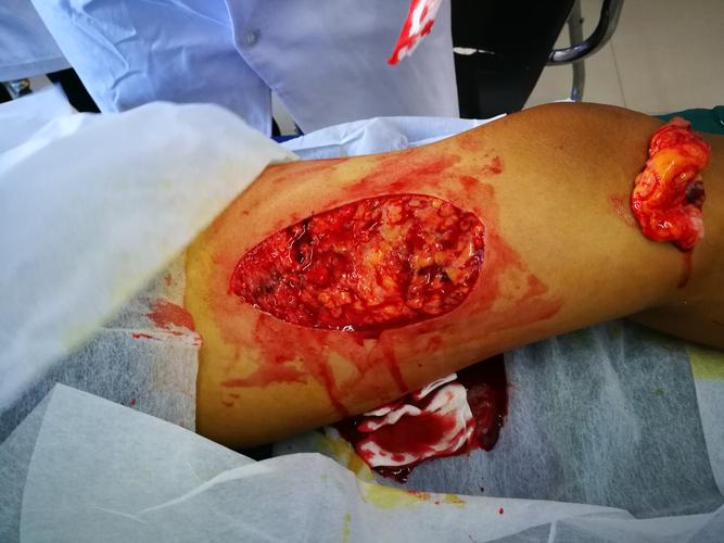 左胫腓骨粉碎性开放性骨折伴骨折处软组织剥脱挤压伤及右内后踝软组织