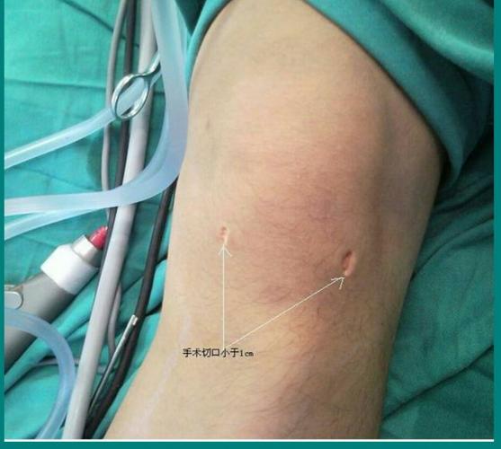 膝关节镜下半月板损失的诊断及治疗