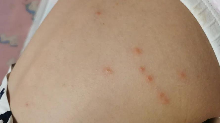 常君医生治疗热毒疹案例一则