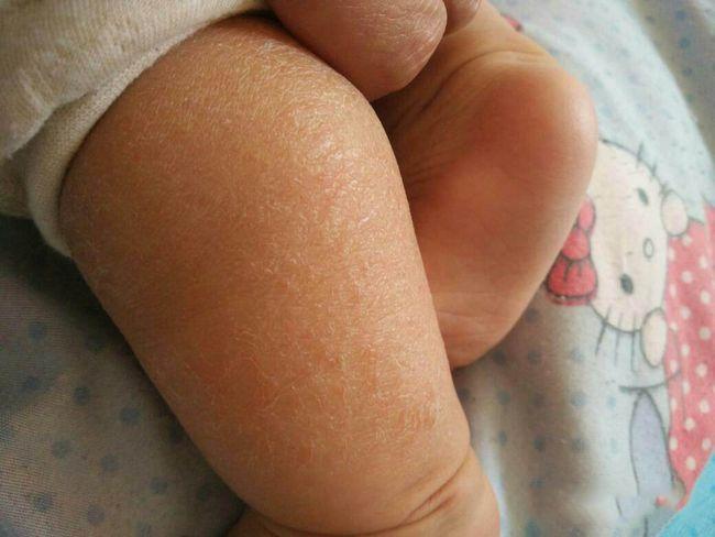 宝宝出现湿疹时一般什么症状呢?