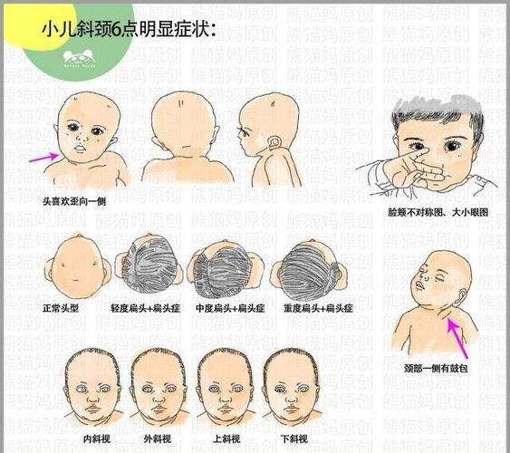 其它 宝宝"歪脖子"怎么办 写美篇婴儿儿斜颈,(俗称"歪脖子"),是由于