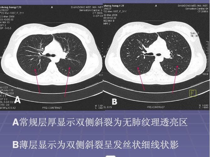 正常胸肺部ct影像学