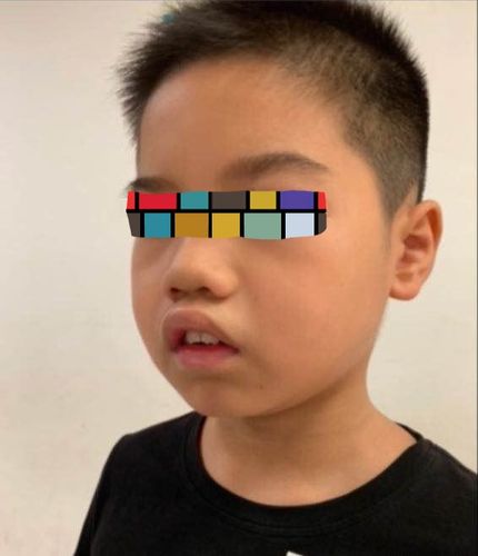 腺样体面容的成因及防治