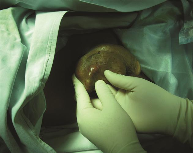 阴囊多发纤维增生病变1例