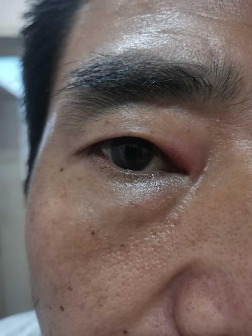 眼痒上眼皮红肿