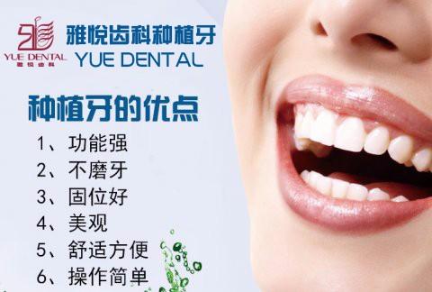 雅悦齿科种植牙介绍