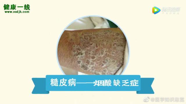 怕是糙皮病惹得货!