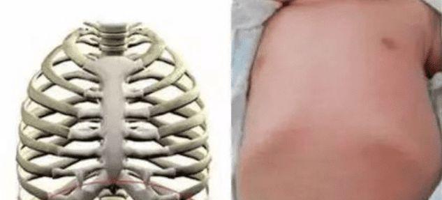 宝宝肋骨外翻是佝偻病解析婴儿肋骨外翻的原因家长要及时了解