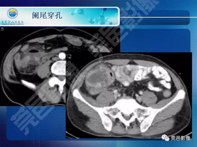 急性阑尾炎的ct表现