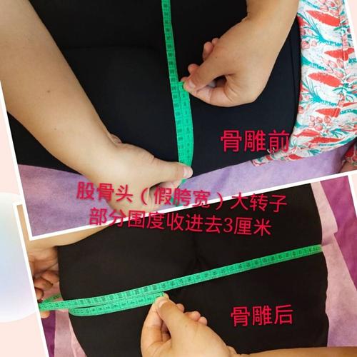 【车氏骨雕】骨盆修复第一次,胯骨围度和股骨头大转子(假胯宽)围度各
