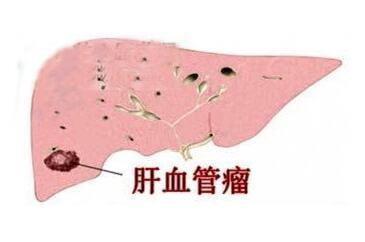 发现肝脏血管瘤要如何治疗会有危险吗听听医生怎么说