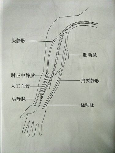 avg(j型) 右侧 上臂头静脉-桡动脉 吻合(↓)
