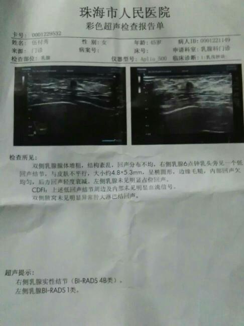 结构紊乱,回声分布不均,右侧乳腺6点钟乳头旁见一个低回声结节,与皮肤
