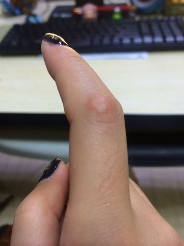 手指关节这长了个硬疙瘩 是怎么了