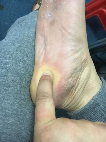 脚后跟疼,着地就疼,特别是早上起床或者休息了一下再站起来脚后跟就不