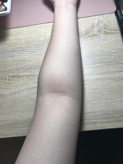 uus 请问这是肘外翻吗