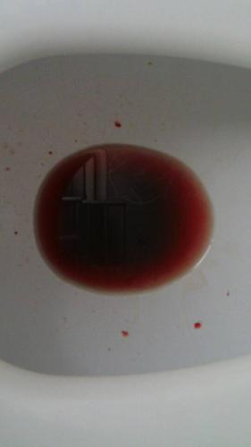 已经连续1个礼拜的 便血了 现在不拉便 肛门也有血迹