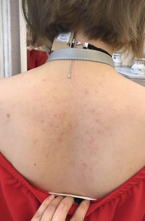 后背不停长痘痘可能毛孔被上亿只螨虫掏空用上3方法祛痘最快