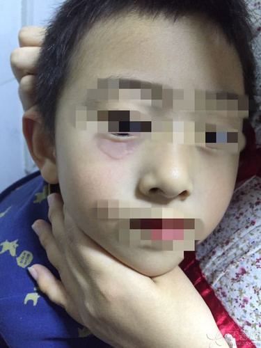 下眼睑皮肤皮疹