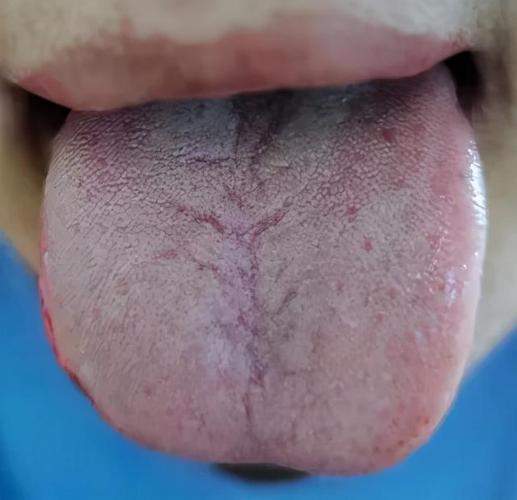 1,舌头 中间有裂纹,说明脾胃气虚.