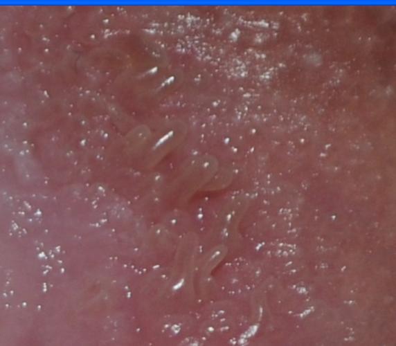 阴道口长了些米状小颗粒,医托,大篇的广告勿扰.症状如图,无不良性史