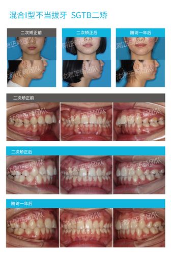 下图为沈刚正畸团队为某混i病例使用sgtb进行二矫时口内口外对比照