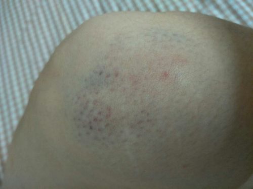 今天不小心摔倒了,膝盖磕在了地上!怎样能快速的好啊?