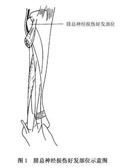 腓总神经卡压症