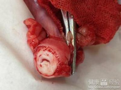 子宫颈囊肿怎么形成的