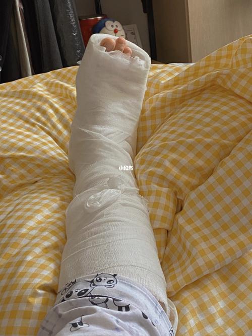 打了石膏是真的会小腿肌肉萎缩吗?_医疗健康_医疗健康