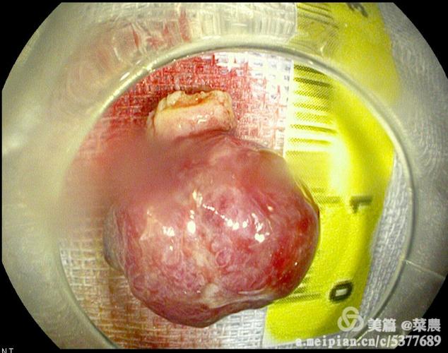 带蒂息肉内镜切除