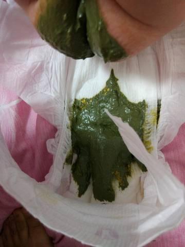 两个月宝宝拉这种粑粑正常吗?黄色带颗粒的,之前是拉