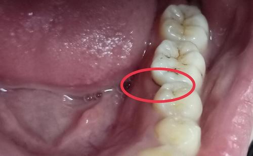 有牙根龋影响正畸吗正畸可以补龋齿吗