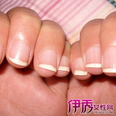 指甲发白是怎么回事 指甲出现问题是体质较差之兆