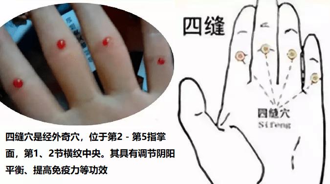 四缝穴,扎一次见效,扎二次痊愈,真是绝了!