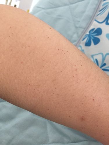 会不会是白血病的前兆