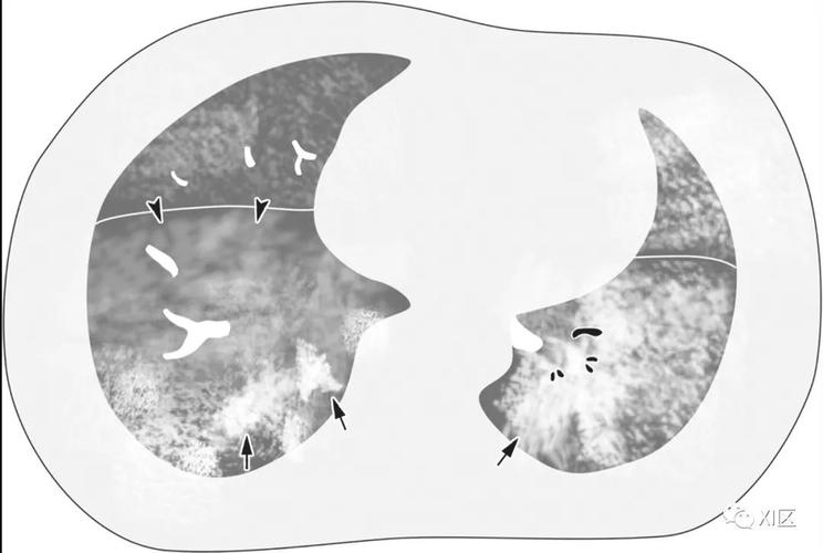 病毒性肺炎的影像学表现