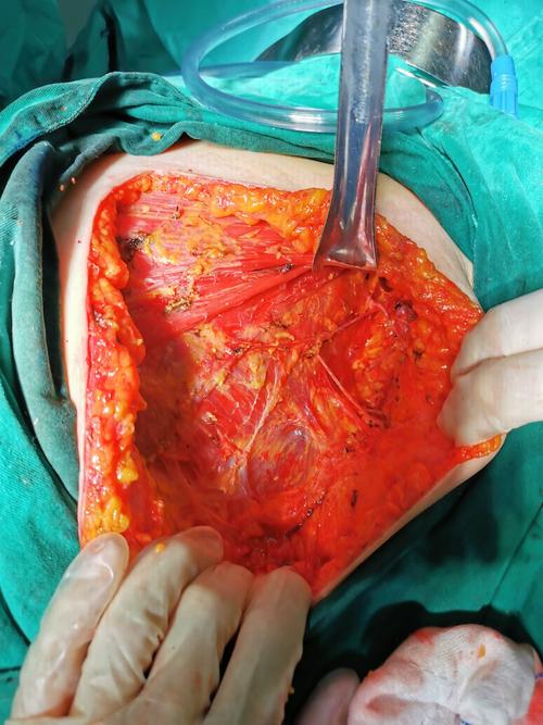 乳腺癌手术,甲状腺腺叶切除术(血管,神经赤裸化),手术更精细!