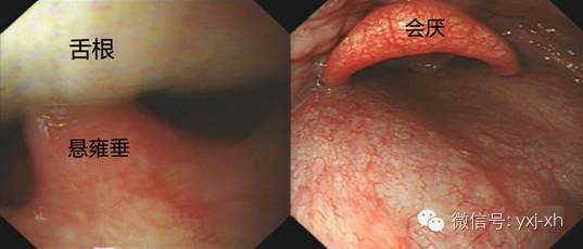 3,咽部到食管入口的操作:胃镜通过舌根后即可看到会厌软骨,动作轻盈时
