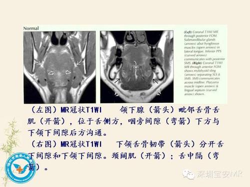 舌和口底影像解剖及临床病例