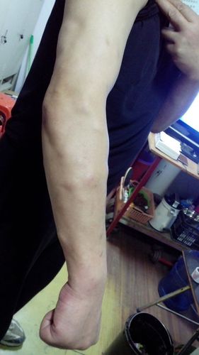 全身有脂肪瘤,以前有做过手术