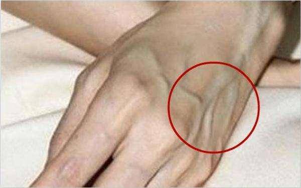 手指背面的青筋呈黑色,可能患有 颈椎肥大症或者腰椎病.