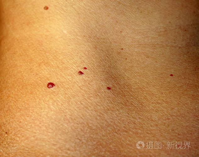 在皮肤上的血管瘤.身体上的红痣.许多的胎记