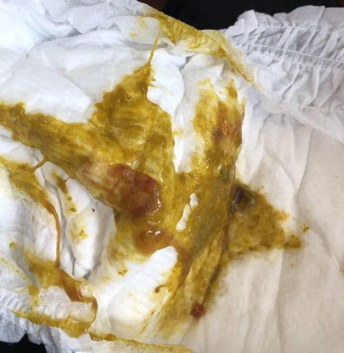 宝宝大便有粘液是怎么回事?宝宝的大便有泡沫,需要加乳糖酶吗?