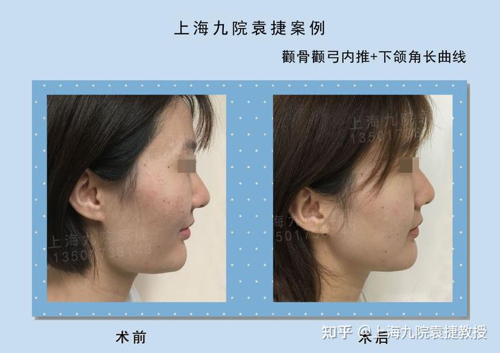 颧骨颧弓内推下颌角截骨案例