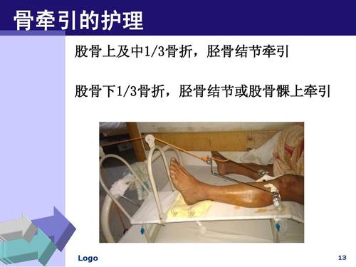 骨牵引的护理 股骨上及中1/3骨折,胫骨结节牵引 股骨下1/3骨折,胫骨