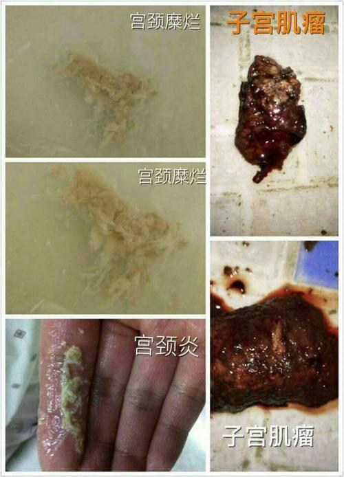 你知道自己子宫内藏有多垃圾?快来看看吧!