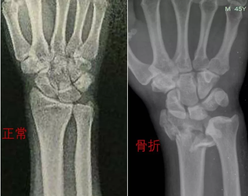 骨科知识 | 手腕骨折了该怎么办?