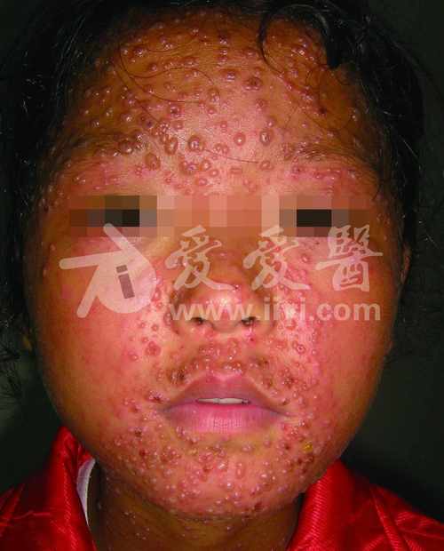 皮肤性病科图谱病毒性皮肤病水痘