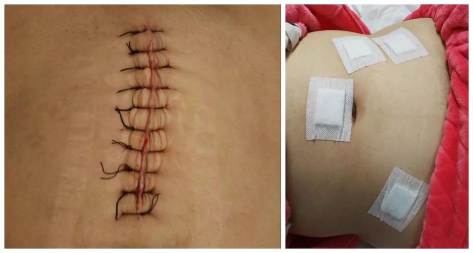 传统的开腹手术与腹腔镜手术刀口对比